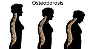 Progressive affects of osteoporosis on the spine